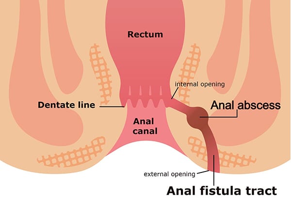 Fistula: Causes, Types, And Treatment